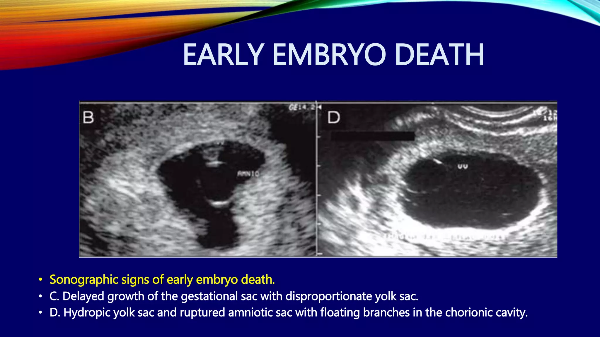 EARLY EMBRYO DEATH
• Sonographic signs of early embryo death.
• C. Delayed growth of the gestational sac with disproportionate yolk sac.
• D. Hydropic yolk sac and ruptured amniotic sac with floating branches in the chorionic cavity.
 