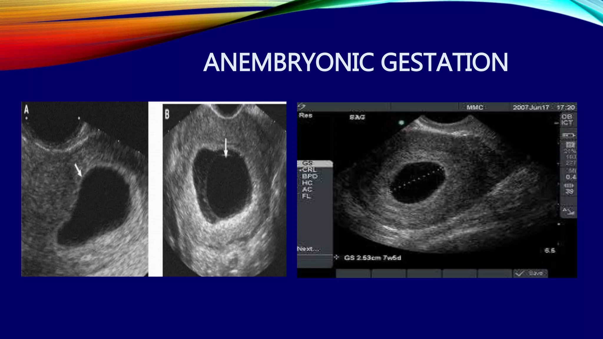 ANEMBRYONIC GESTATION
 
