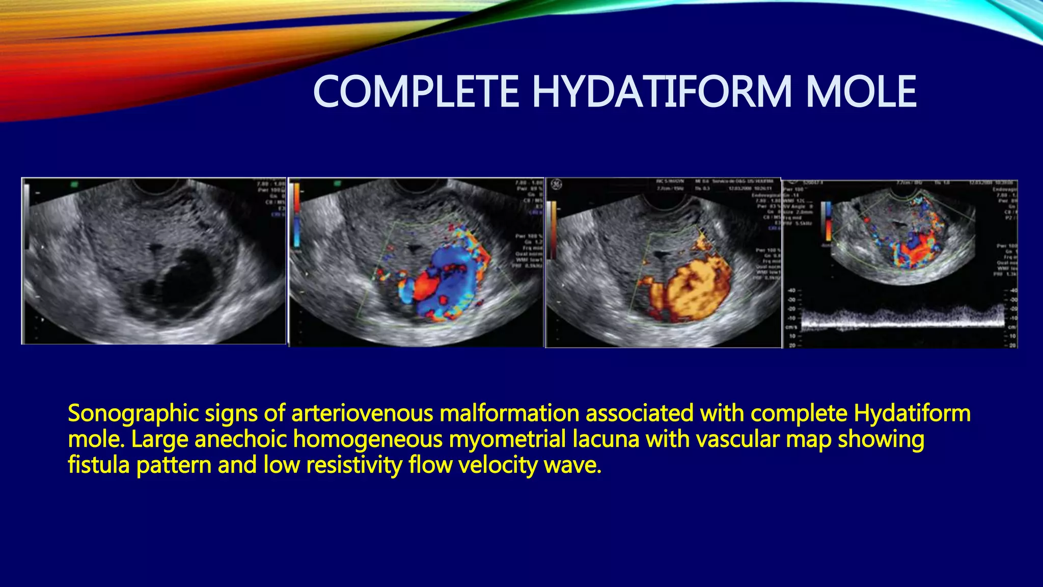 COMPLETE HYDATIFORM MOLE
Sonographic signs of arteriovenous malformation associated with complete Hydatiform
mole. Large anechoic homogeneous myometrial lacuna with vascular map showing
fistula pattern and low resistivity flow velocity wave.
 