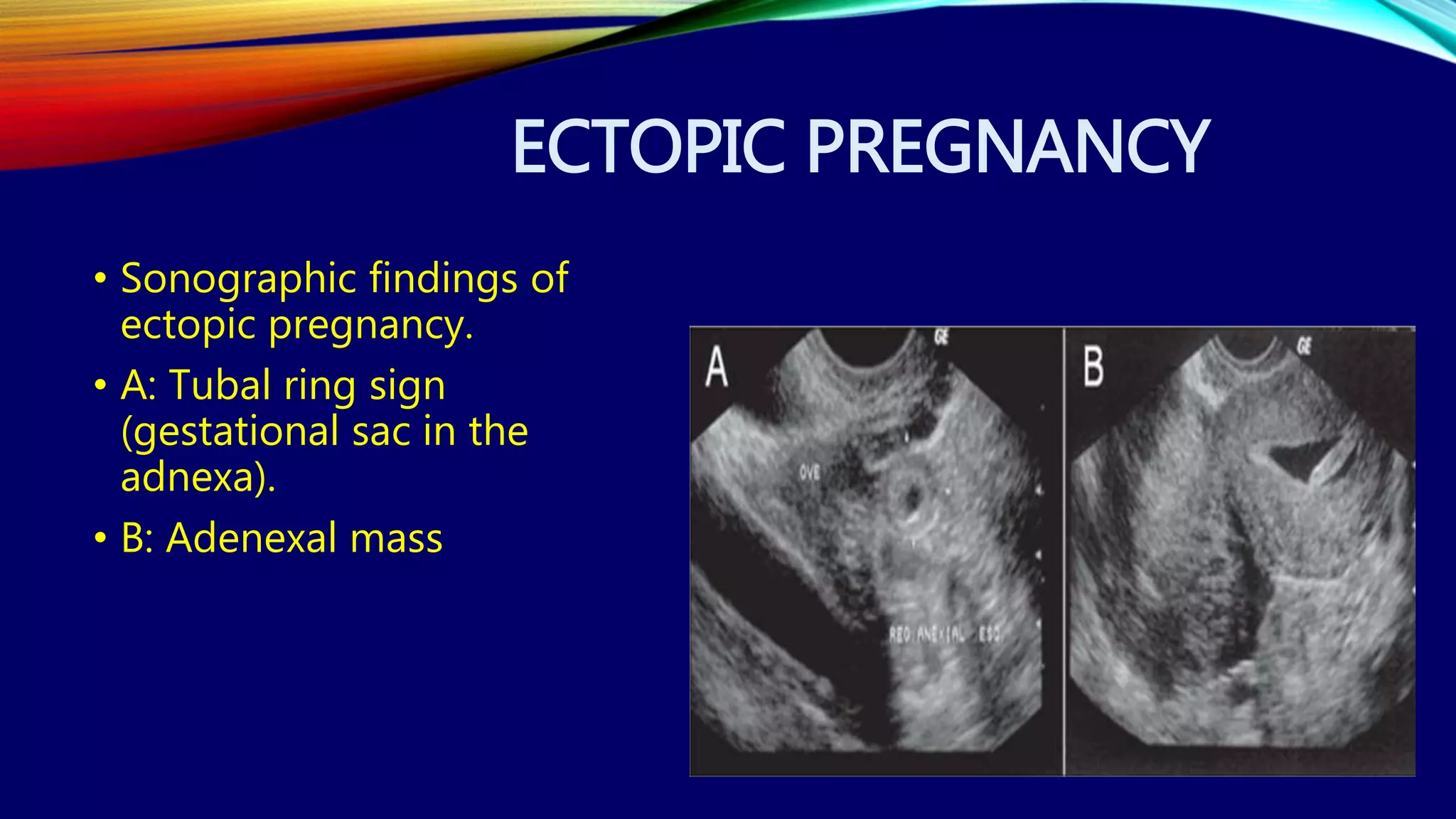 ECTOPIC PREGNANCY
• Sonographic findings of
ectopic pregnancy.
• A: Tubal ring sign
(gestational sac in the
adnexa).
• B: Adenexal mass
 