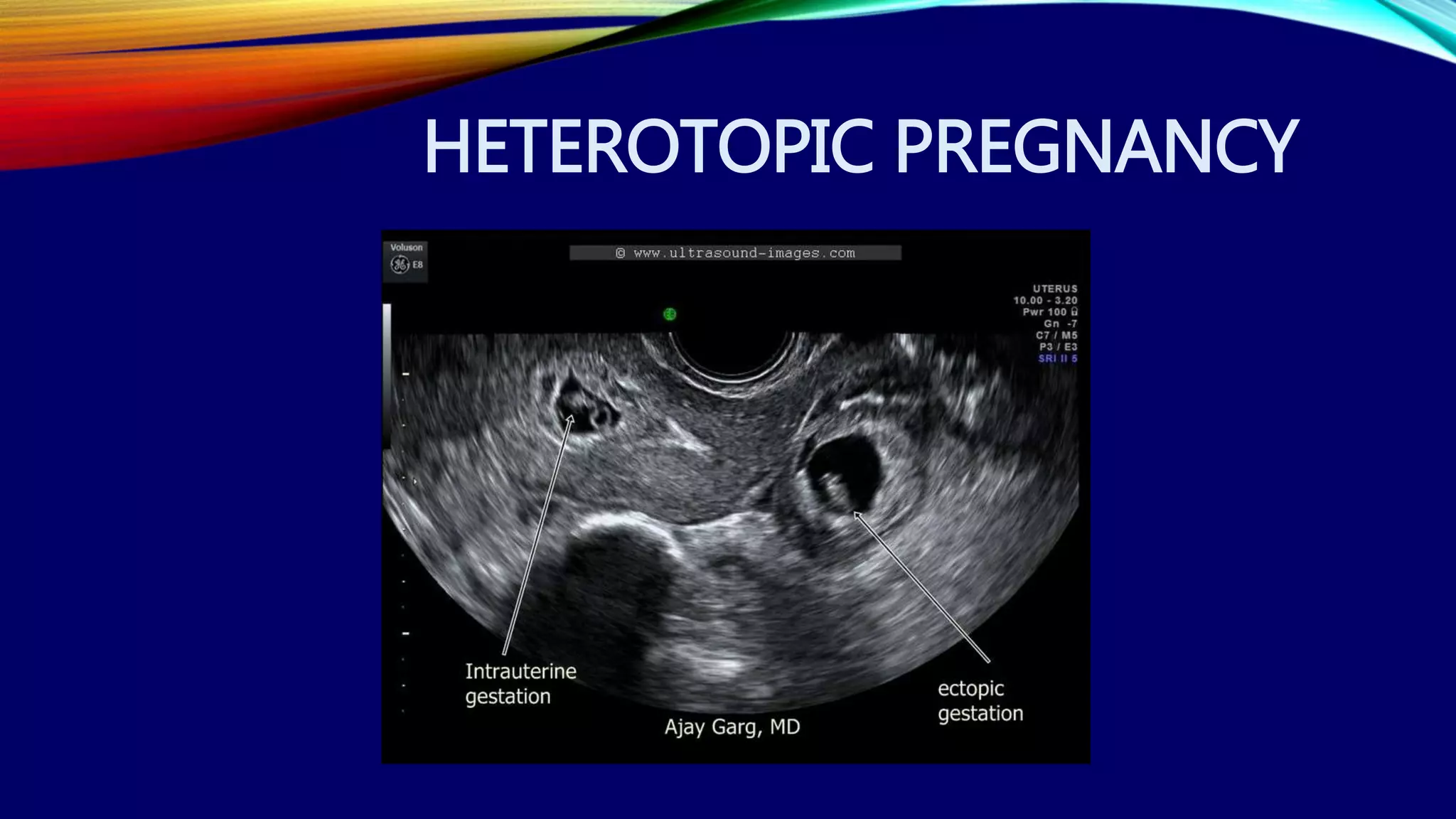 HETEROTOPIC PREGNANCY
 