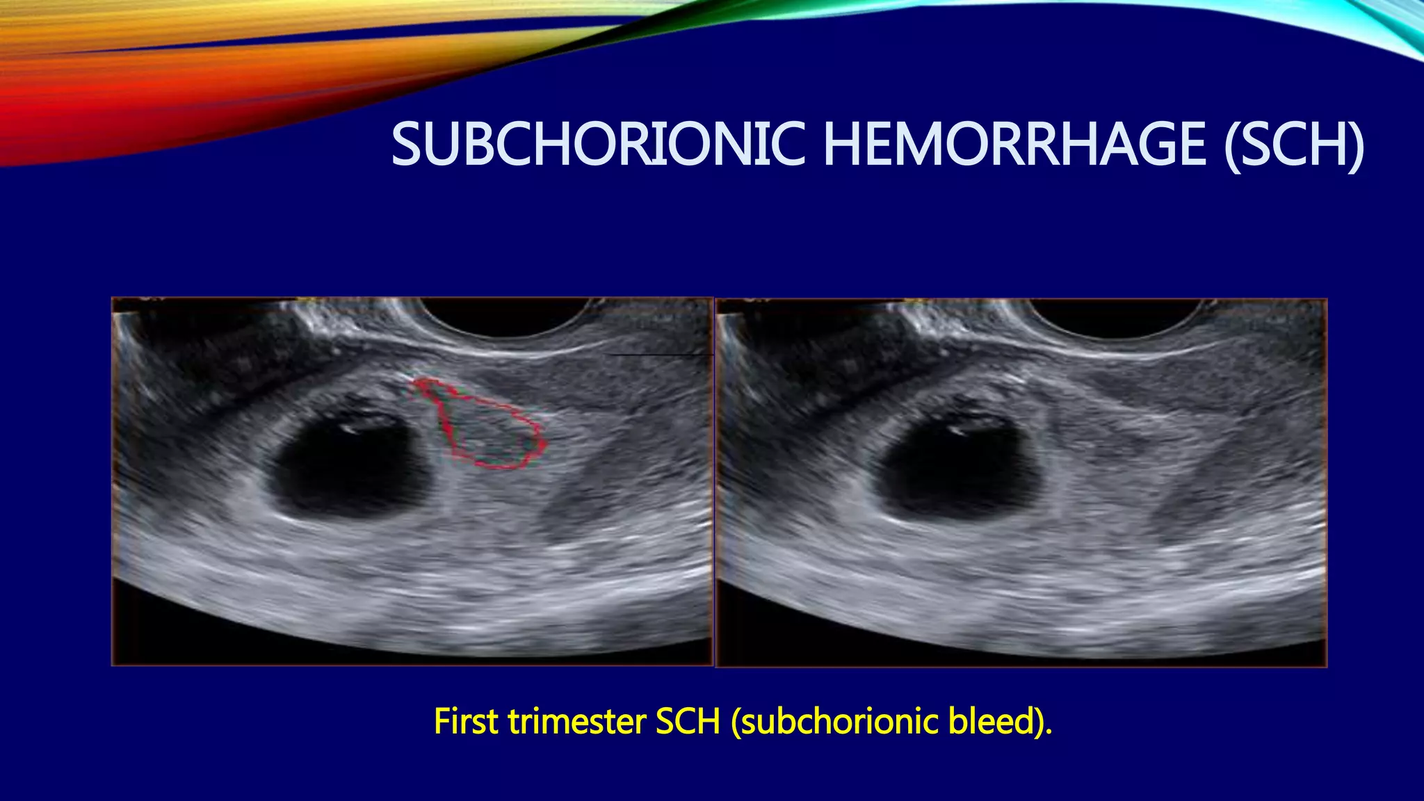 First trimester SCH (subchorionic bleed).
SUBCHORIONIC HEMORRHAGE (SCH)
 