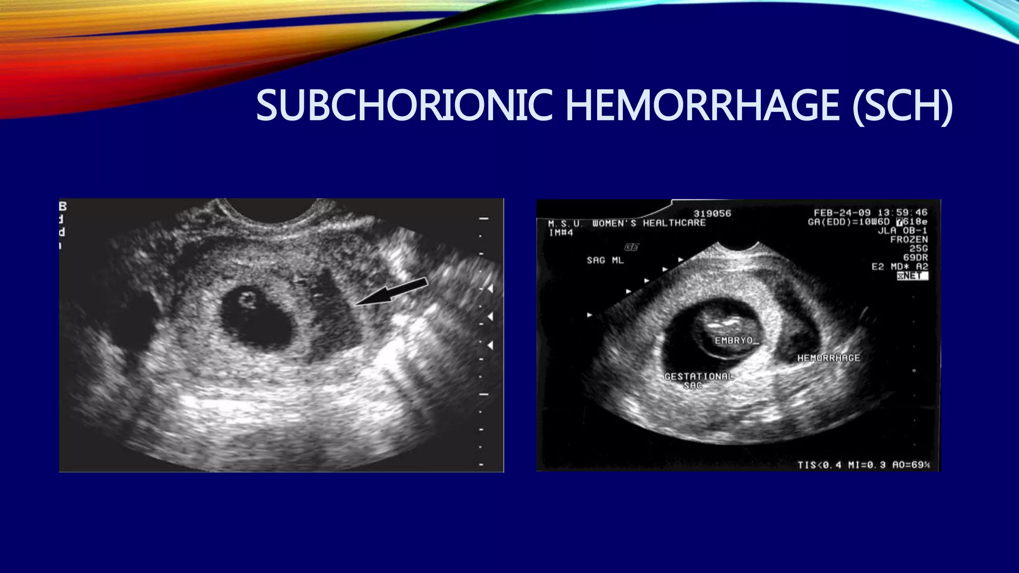 SUBCHORIONIC HEMORRHAGE (SCH)
 