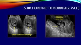 Subchorionic Infarct First trimester ultrasound Dr. Muhammad Bin Zulfiqar | PPTX