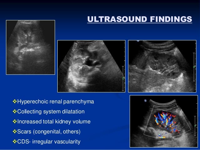 First Urinary Tract Infection Episode in Children