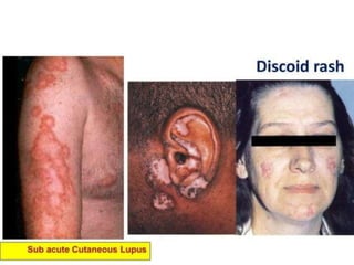 The causes of lymphoedema
Primary Congenital genetic disorders causing dilatation,
incompetence, aplasia or obliteration of the lymphatics
Secondary Neoplastic infiltration of lymph glands by:
secondary carcinoma lymphomas (Hodgkin’s/non-
Hodgkin’s)
Infection
Filariasis
Lymphogranuloma inguinale
Tuberculosis
Recurrent non-specific infection Iatrogenic
Surgical excision of lymph glands Irradiation of lymph
glands
 