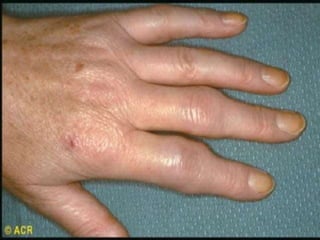 ‫الرحيم‬ ‫الرحمن‬ )‫ا‬ ‫بسم‬
Faculty Of Medicine And Health Science.
Surgical Department
Inguino-Scrotal Conditions
Dr.Anas Asafrah
General surgeon
Aug-2024
 