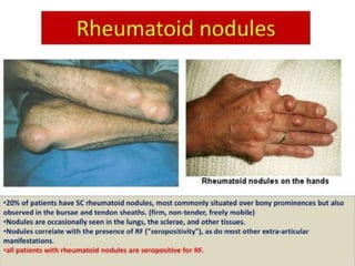 lnguinal Region
Dłsseclion - î'oslerlor {Internal) View
 