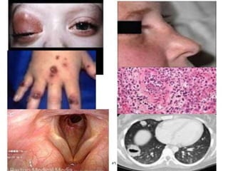 Standing position
• Feelfrom front
Scrotal neck test
• Technique:
Can you get above the
testis?
Inguinal, scrotal,
inguinoscrotal.
.
 
