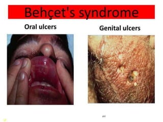 Superficial ring test
Technique
Direct, indirect inguinal
 