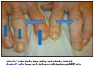 Standing position
• Feelfromtheside:
— Stand at the same side of the hernia,
one hand over the back of the patient
to support him.
— Examine with your fingers.
— Findings:
• Site
• Size
 