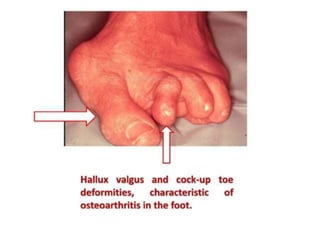 • shape
• Temperature
• Tenderness.
• Composition.
• Reducibility.
• Expansile impulse with cough.
 