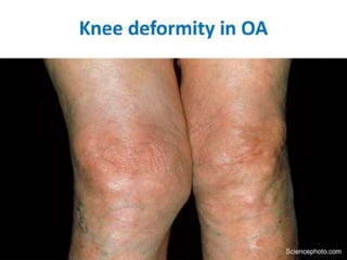 Standing position
• Expansile impulse with cough:
—
Technique.
-The swelling should become tense and expand
with coughing, not moves up and down only in one
direction.
• It is diagnostic for hernia but can be absent in
complicatecl ones.
 