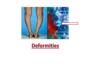 Expansile impulse with cough
 