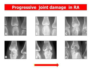 Inguinodynia:
• Acute Appendicitis.
• hidden hernia.
• Diverticulitis.
• Inflammatory Bowel Disease.
• Prostatitis.
• Testicular disorders, Torsion.
• UTI.
• Renal colic.
• Osteitis Pubis.
• Musculoskeletal pain.
• Neuropathy.
 