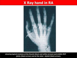 • Richter's hernia?
• MaydI's hernia?
• Sliding hernia?
• Pantaloon hernia?
• Amyand hernia?
• Spigelian hernia?
• Littre’s hernia ?
????
 