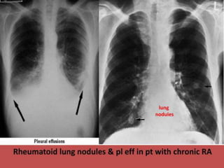 The Most Important Symptoms
are:
● Cough
● Sputum production
● Hemoptysis
● Breathlessness
● Wheeze
● Chest pain
 