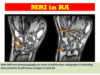 How To Assess Cough ?
It is important to ask about :
● Frequency: Intermittent or Persistent
● Severity: Diurnal variation
● Character: dry or productive
● Associated symptoms: e.g chest pain
● What is responsible or triggered by:
• Sputum in the respiratory tract e.g. in acute infections
or Bronchiectasis
• Cigarette smoke
• Pungent smell
• Cold air
 