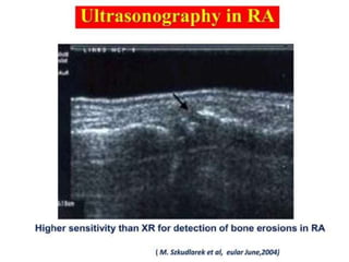 Loading…
2.SPUTUM
TYPES:
● Mucoid as in Chronic Bronchitis
● Green or Yellow in Infection
● Bloody in bronchogenic carcinoma, T.B
● Rusty colour in Pneumonia
● Pink and frothy in Pulmonary oedema
● Foul smelling suggest anaerobic infection
● Clear watery, large volume (Bronchorrhea ) in alveolar cell
carcinoma
 