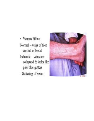 Causes Of Lateral Chest Pain:
Pleural Pain:
● Sharp and stabbing in character
● Localized or referred to shoulder tip if diaphragmatic
pleura is involved
● Worse on deep inspiration or cough, if severe,
shallow breathing, avoidance of movement, and
cough suppression
● Results from inflammatory or malignant involvement
of the parietal pleura e.g. Pneumonia, Pulmonary
infarction, Malignancy, Lung abscess, Rheumatoid
arthritis
 