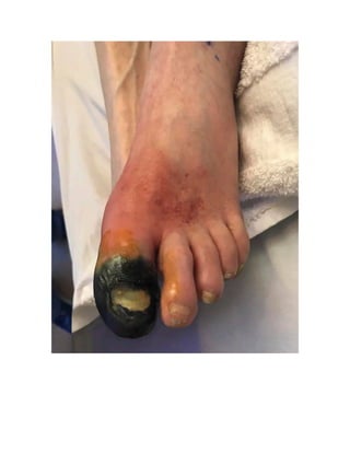 SUMMARY
CAUSES OF CHEST PAIN
STRUCTURE Possible CAUSE of pain
Pleura Inflammation, infarction
Muscle Strain from coughing
Bone Rib fracture or Tumour
Costochondral junction Tietze’s syndrome
Nerves Herpes zoster, Pancoast tumor
Heart and great vessels Cardiac ischemia, Infarction,
aortic dissection, aneurysm
Esophagus Spasm reflux
 