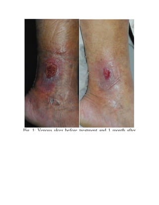 Inspection: Hands
• Nicotine staining
• Peripheral cyanosis
• Clubbing
• Wasting of small muscles of the hands
• Tremor Bronchiectasis
Lung abscess
Empyema
Lung cancer
Mesohelioma
Idiopathic pulmonary fibrosis
Asbestosis
Cystic fibrosis
Clubbing:
 