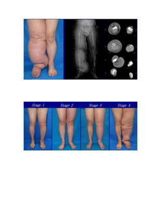 Hands: Finger clubbing
● Look across nail and nail bed angle
● Demonstrate increased nail bed fluctuation
 