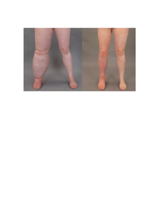 HPOA:
• Clubbing + arthralgia with joint swelling of
wrists and ankles
• X-rays show subperiosteal new bone formation
Right ankle
radiograph
demonstrating
periosteal
reaction along
distal tibial
and fibular
diaphysis
(arrows).
 