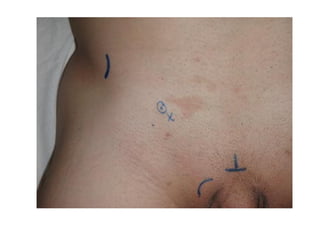 Pleural rub:
• Creaking sound due to two inflamed layers of
pleural membrane rubbing against each other
during inspiration  expiration
• Patient may also have pleuritic chest pain at the
same site
• Causes: pneumonia, pulmonary embolism 
vasculitis
 