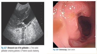 • Factors that reduce oxygen demand or
increase oxygen supply will result in relief
of angina. These include cessation of
activity or termination of the provoking
factor, use of nitroglycerin (which is a
venodilator, reducing venous return, and a
coronary artery vasodilator that increases
coronary blood flow), and sitting up (which
reduces venous return and preload).
 