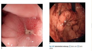 Associated symptoms
Dyspnea in the setting of angina may reflect pulmonary congestion due to an
elevation in left ventricular end diastolic pressure related to failure of the
myocardium to relax normally in diastole (as relaxation or lusitropy is energy
dependent
.)
 