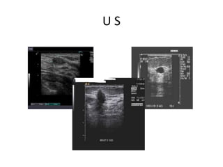 •
Postural hypotension is a fall of 20
mmHg in systolic BP on standing. It can
be caused by hypovolaemia,
antihypertensive drug therapy, especially
diuretics and vasodilators (Box 6.7), and
autonomic neuropathy. Postural
hypotension is common in the elderly,
affecting up to 30% of individuals aged
65 years
.
 