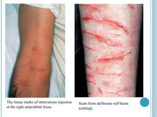 Scars from deliberate self-harm
(cutting).
The linear marks of intravenous injection
at the right antecubital fossa.
 