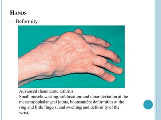 HANDS
• Deformity
Advanced rheumatoid arthritis.
Small muscle wasting, subluxation and ulnar deviation at the
metacarpophalangeal joints, boutonnière deformities at the
ring and little fingers, and swelling and deformity of the
wrist.
 