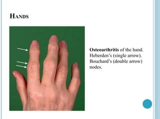 HANDS
Osteoarthritis of the hand.
Heberden’s (single arrow).
Bouchard’s (double arrow)
nodes.
 