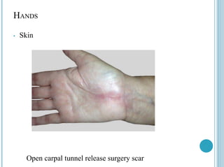 HANDS
• Skin
Open carpal tunnel release surgery scar
 