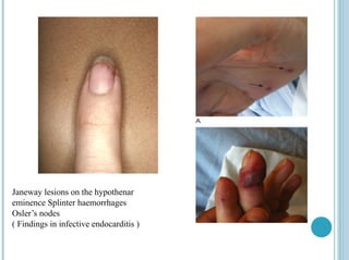 Janeway lesions on the hypothenar
eminence Splinter haemorrhages
Osler’s nodes
( Findings in infective endocarditis )
 
