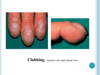 Clubbing. Anterior view and Lateral view.
 