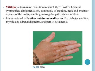 • Vitiligo; autoimmune condition in which there is often bilateral
symmetrical depigmentation, commonly of the face, neck and extensor
aspects of the limbs, resulting in irregular pale patches of skin.
• It is associated with other autoimmune diseases like diabetes mellitus,
thyroid and adrenal disorders, and pernicious anemia
 
