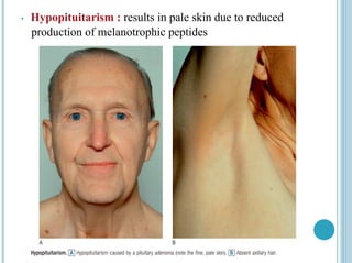 • Hypopituitarism : results in pale skin due to reduced
production of melanotrophic peptides
 