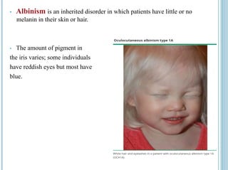 Loading…
• Albinism is an inherited disorder in which patients have little or no
melanin in their skin or hair.
• The amount of pigment in
the iris varies; some individuals
have reddish eyes but most have
blue.
 