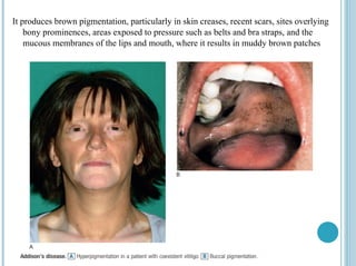 It produces brown pigmentation, particularly in skin creases, recent scars, sites overlying
bony prominences, areas exposed to pressure such as belts and bra straps, and the
mucous membranes of the lips and mouth, where it results in muddy brown patches
 