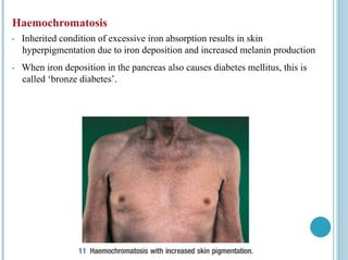 Haemochromatosis
• Inherited condition of excessive iron absorption results in skin
hyperpigmentation due to iron deposition and increased melanin production
• When iron deposition in the pancreas also causes diabetes mellitus, this is
called ‘bronze diabetes’.
 