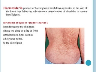 Haemosiderin product of haemoglobin breakdown deposited in the skin of
the lower legs following subcutaneous extravasation of blood due to venous
insufficiency.
(erythema ab igne or ‘granny’s tartan’)
heat damage to the skin from
sitting too close to a fire or from
applying local heat, such as
a hot water bottle,
to the site of pain
 