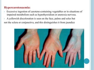 Hypercarotenaemia:
• Excessive ingestion of carotene-containing vegetables or in situations of
impaired metabolism such as hypothyroidism or anorexia nervosa.
• A yellowish discoloration is seen on the face, palms and soles but
not the sclera or conjunctiva, and this distinguishes it from jaundice
 