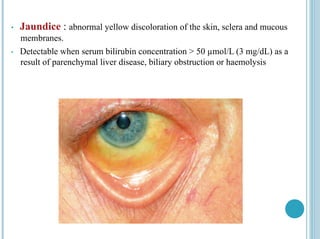 • Jaundice : abnormal yellow discoloration of the skin, sclera and mucous
membranes.
• Detectable when serum bilirubin concentration > 50 µmol/L (3 mg/dL) as a
result of parenchymal liver disease, biliary obstruction or haemolysis
 