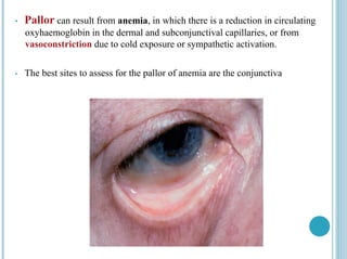 • Pallor can result from anemia, in which there is a reduction in circulating
oxyhaemoglobin in the dermal and subconjunctival capillaries, or from
vasoconstriction due to cold exposure or sympathetic activation.
• The best sites to assess for the pallor of anemia are the conjunctiva
 