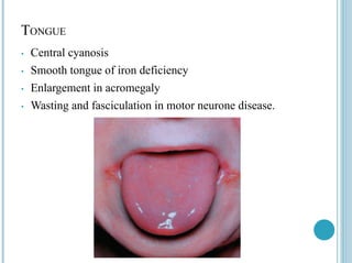 TONGUE
• Central cyanosis
• Smooth tongue of iron deficiency
• Enlargement in acromegaly
• Wasting and fasciculation in motor neurone disease.
 