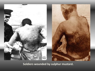 Soldiers wounded by sulphur mustard.
 