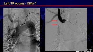 Stent Rima Fischman AM - AIMRADIAL 2014 Endovascular - Interventional radiology | PDF